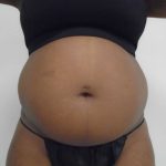 Lipo 360 Before & After Patient #499