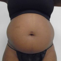 Lipo 360 Before & After Patient #499