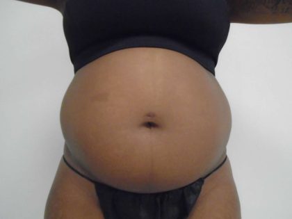 Lipo 360 Before & After Patient #499