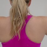 Arm Liposuction Before & After Patient #393