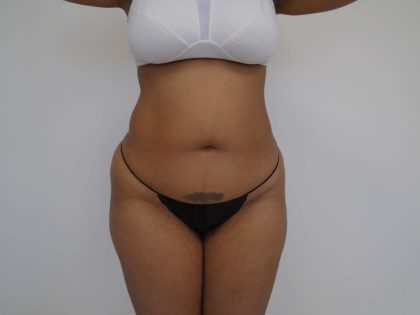 Lipo 360 Before & After Patient #562