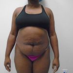 Lipo 360 Before & After Patient #487