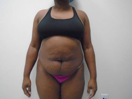 Lipo 360 Before & After Patient #487