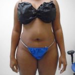 Lipo 360 Before & After Patient #571