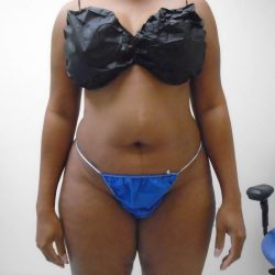 Lipo 360 Before & After Patient #571