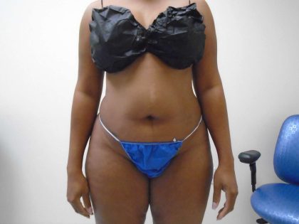 Lipo 360 Before & After Patient #571