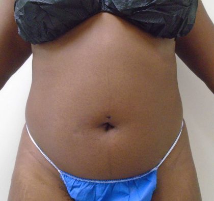 Lipo 360 Before & After Patient #514