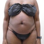 Lipo 360 Before & After Patient #517