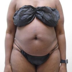 Lipo 360 Before & After Patient #517