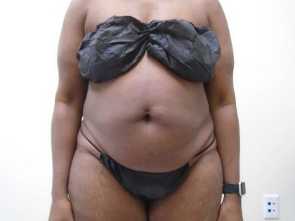 Lipo 360 Before & After Patient #517