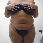 Lipo 360 Before & After Patient #482