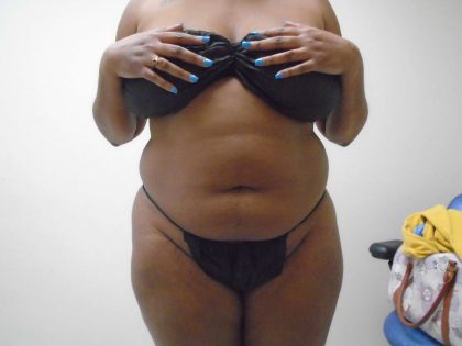 Lipo 360 Before & After Patient #482