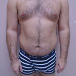 Lipo 360 Before & After Patient #580