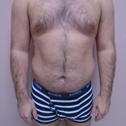 Lipo 360 Before & After Patient #580
