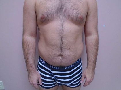 Lipo 360 Before & After Patient #580