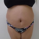Lipo 360 Before & After Patient #535