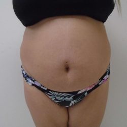 Lipo 360 Before & After Patient #535