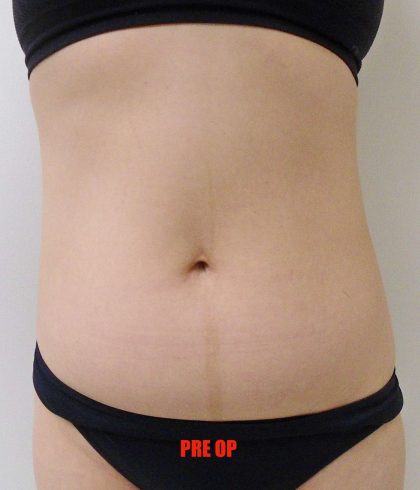 Lipo 360 Before & After Patient #538