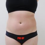 Lipo 360 Before & After Patient #544