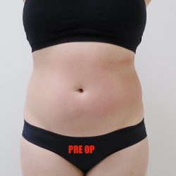 Lipo 360 Before & After Patient #544