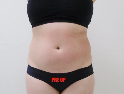 Lipo 360 Before & After Patient #544