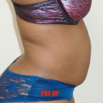 Lipo 360 Before & After Patient #547