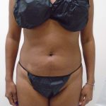 Lipo 360 Before & After Patient #550