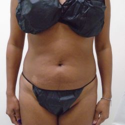 Lipo 360 Before & After Patient #550