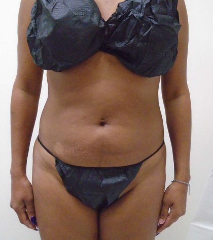 Lipo 360 Before & After Patient #550