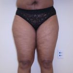 I-Thighs Before & After Patient #574