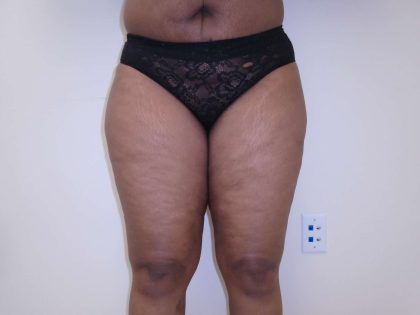 I-Thighs Before & After Patient #574