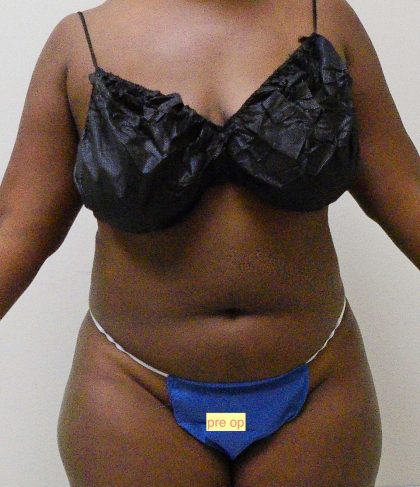 Lipo 360 Before & After Patient #553