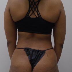 Lipo 360 Before & After Patient #559