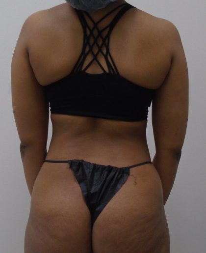 Lipo 360 Before & After Patient #559
