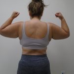 Arm Liposuction Before & After Patient #390