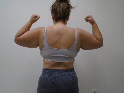 Arm Liposuction Before & After Patient #390