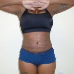 Lipo 360 Before & After Patient #499