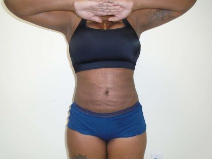 Lipo 360 Before & After Patient #499