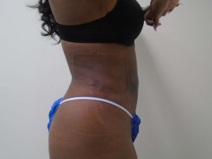 Lipo 360 Before & After Patient #505