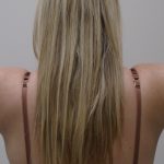 Arm Liposuction Before & After Patient #393