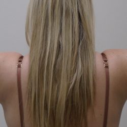 Arm Liposuction Before & After Patient #393