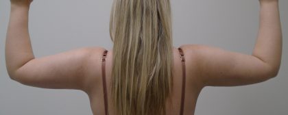 Arm Liposuction Before & After Patient #393