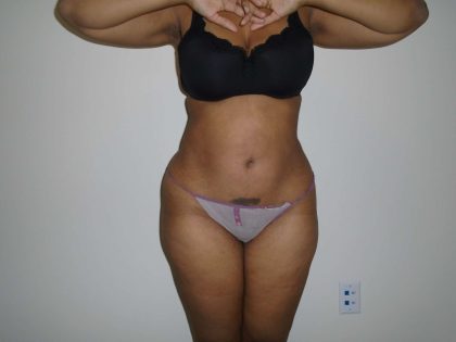 Lipo 360 Before & After Patient #562