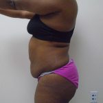 Lipo 360 Before & After Patient #487
