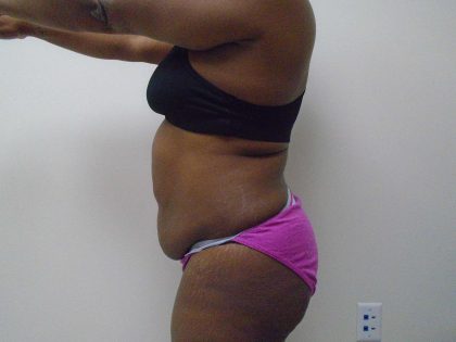 Lipo 360 Before & After Patient #487