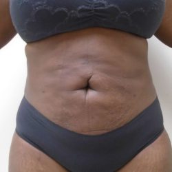 Lipo 360 Before & After Patient #517