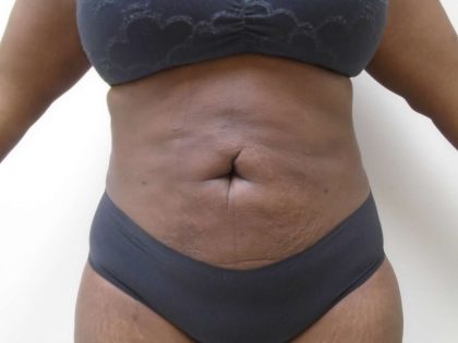 Lipo 360 Before & After Patient #517