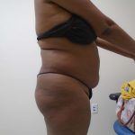 Lipo 360 Before & After Patient #482
