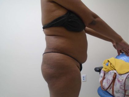 Lipo 360 Before & After Patient #482
