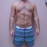 Lipo 360 Before & After Patient #580